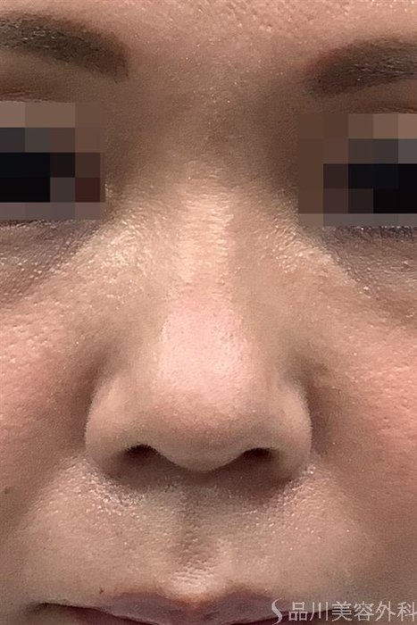 症例NO.55216のBEFORE写真