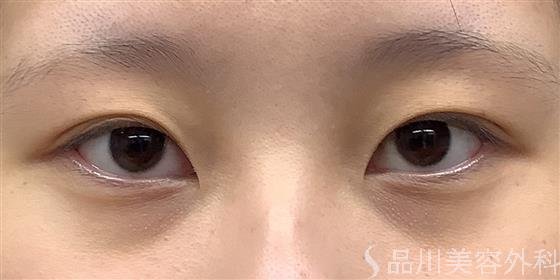 症例NO.58925のBEFORE写真