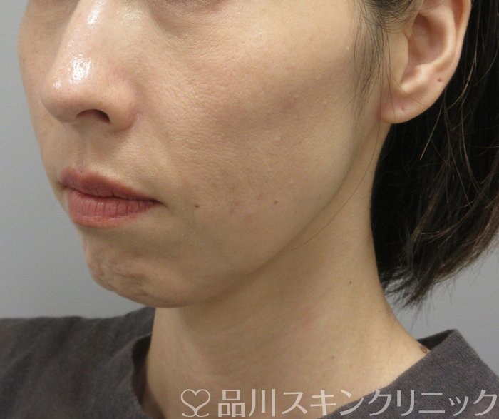 症例NO.74366のAFTER写真