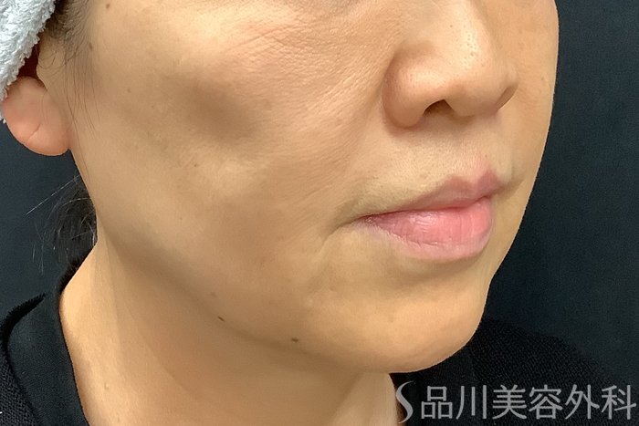 症例NO.73309のBEFORE写真