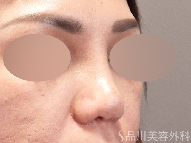 症例NO.67918のAFTER写真