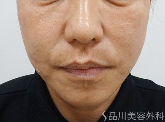 症例NO.72847のAFTER写真