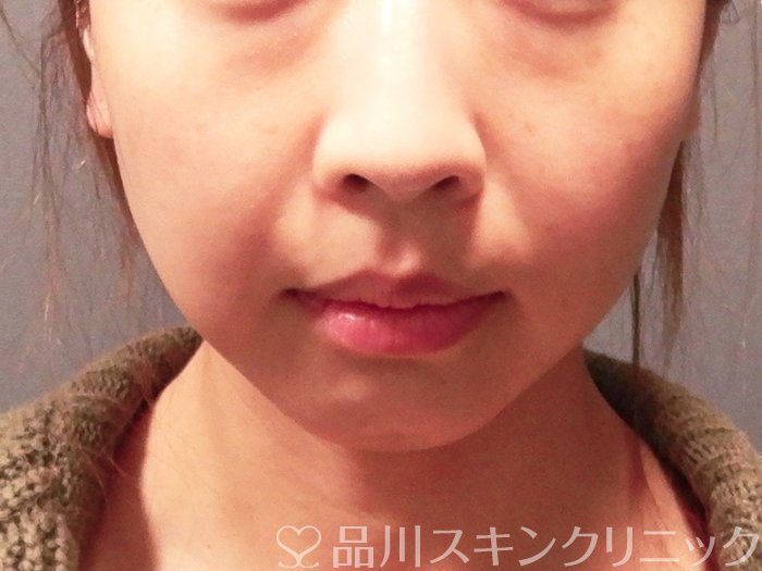 症例NO.63155のBEFORE写真