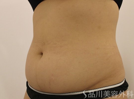 症例NO.70965のBEFORE写真