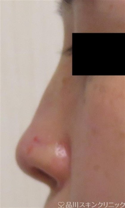 症例NO.58049のAFTER写真