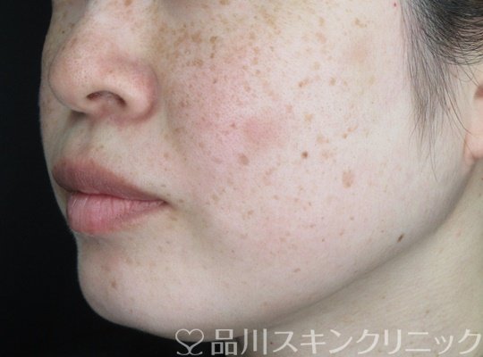 症例NO.70043のAFTER写真