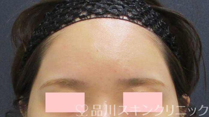 症例NO.69554のAFTER写真