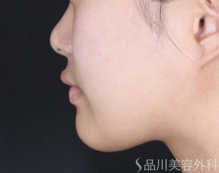 症例NO.72333のBEFORE写真
