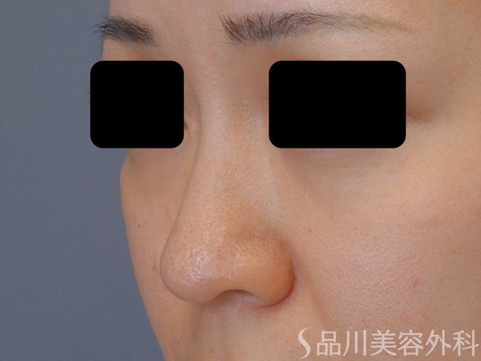 症例NO.72466のBEFORE写真