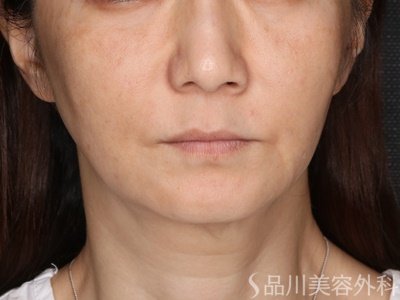 症例NO.73684のBEFORE写真