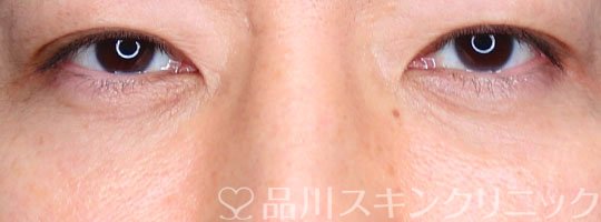 症例NO.68704のAFTER写真