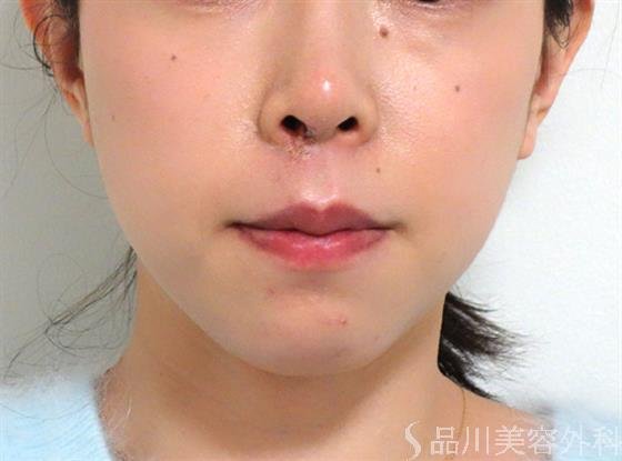 症例NO.27578のAFTER写真