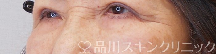症例NO.70023のAFTER写真