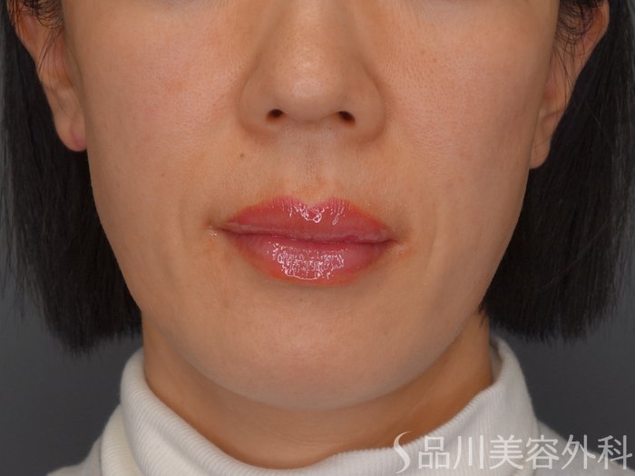 症例NO.69602のBEFORE写真