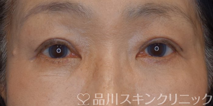 症例NO.74677のAFTER写真