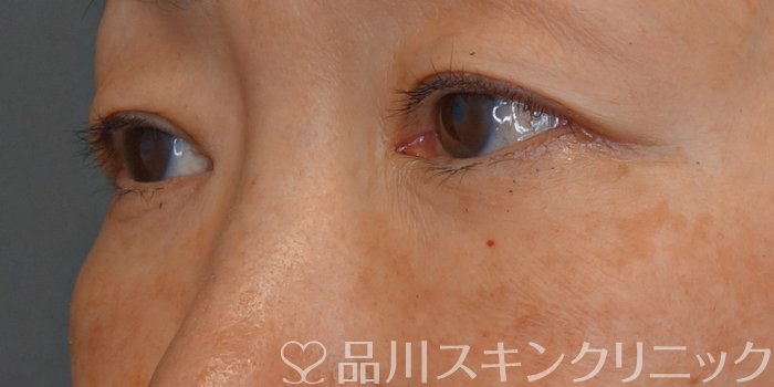 症例NO.72559のBEFORE写真