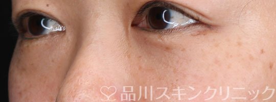 症例NO.65172のAFTER写真