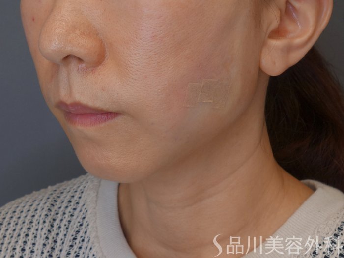 症例NO.72423のAFTER写真