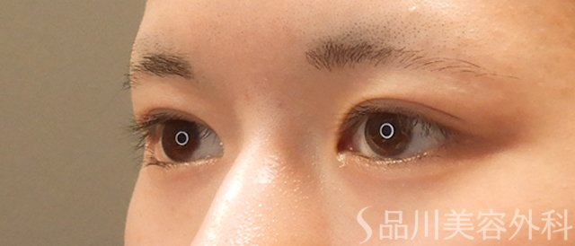 症例NO.73254のBEFORE写真