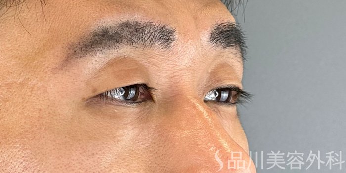 症例NO.70620のBEFORE写真