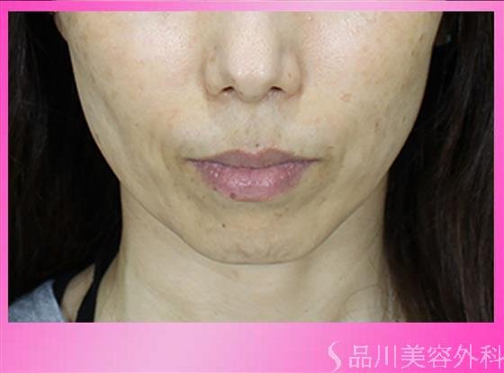 症例NO.49506のBEFORE写真
