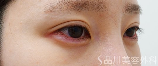 症例NO.70161のAFTER写真