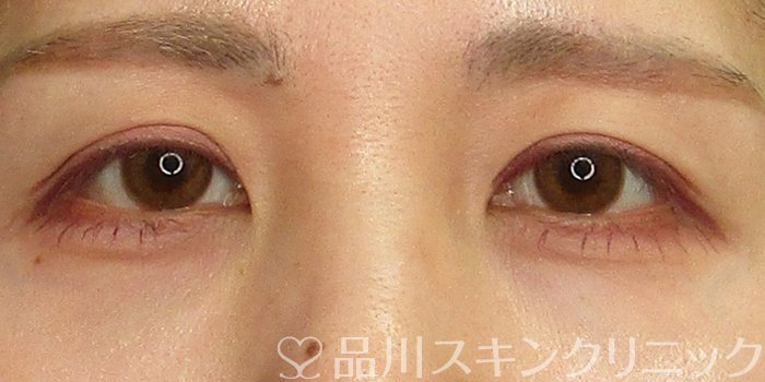 症例NO.70361のBEFORE写真