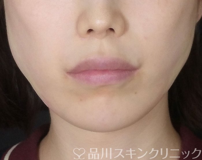 症例NO.69939のAFTER写真