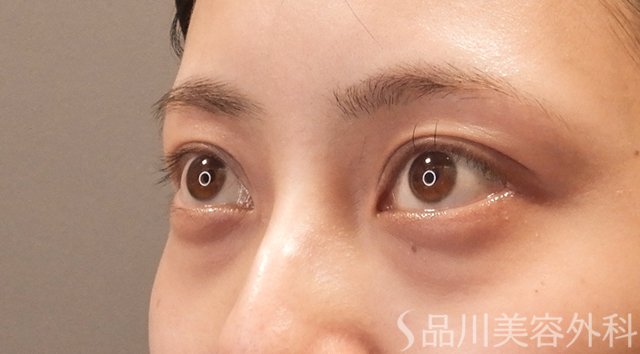 症例NO.74746のBEFORE写真