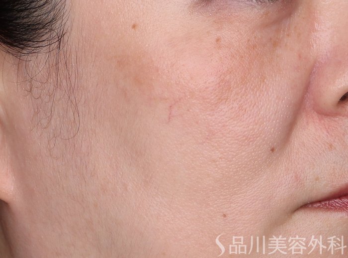 症例NO.71644のAFTER写真