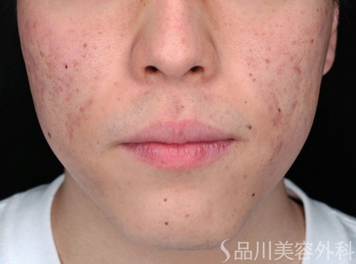 症例NO.71947のBEFORE写真