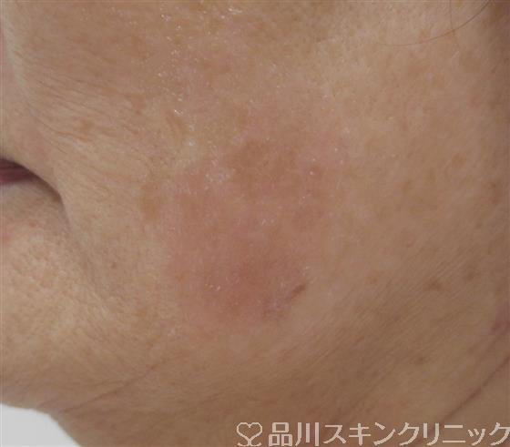 症例NO.42786のAFTER写真