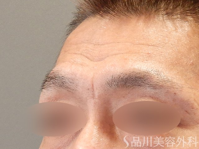 症例NO.75248のBEFORE写真