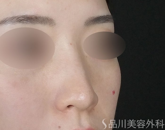 症例NO.72115のBEFORE写真