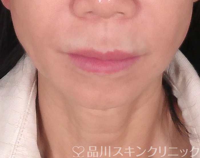 症例NO.70120のBEFORE写真