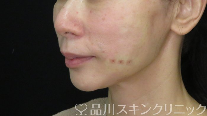 症例NO.72501のAFTER写真