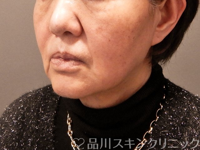 症例NO.69681のBEFORE写真