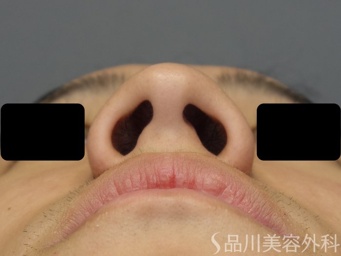 症例NO.67718のBEFORE写真