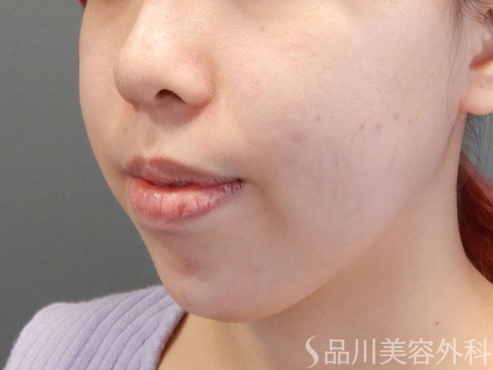 症例NO.70194のAFTER写真