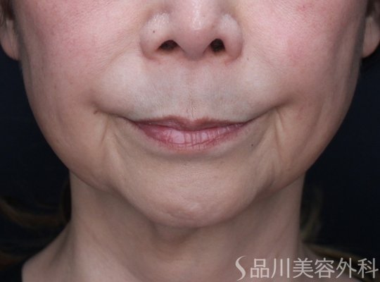 症例NO.72443のBEFORE写真