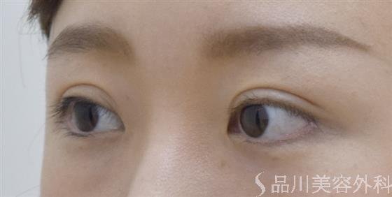 症例NO.51782のAFTER写真