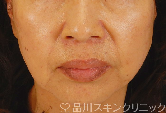 症例NO.65135のAFTER写真