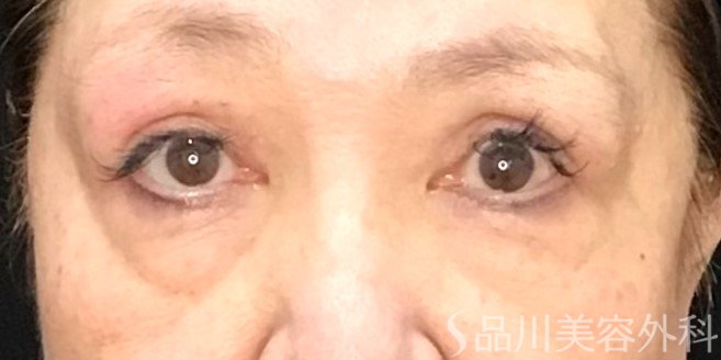 症例NO.71194のBEFORE写真