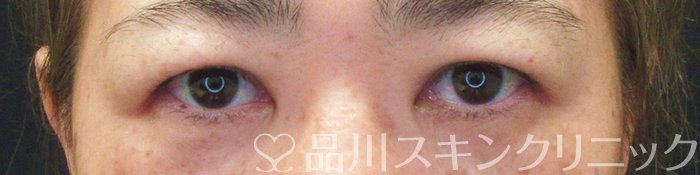 症例NO.70868のBEFORE写真