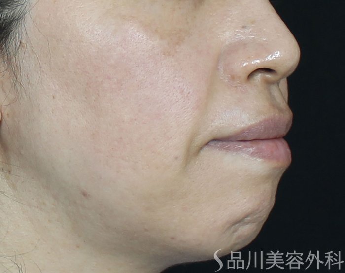 症例NO.68922のBEFORE写真