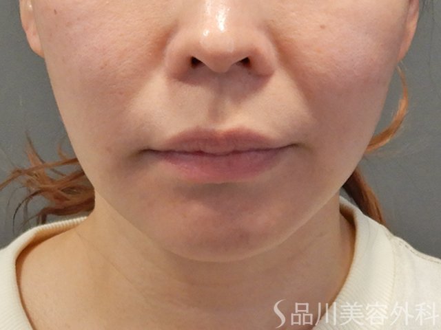 症例NO.73780のBEFORE写真
