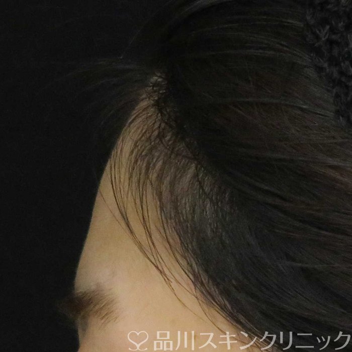 症例NO.62277のBEFORE写真