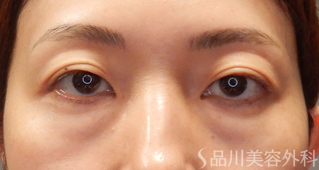 症例NO.74880のBEFORE写真