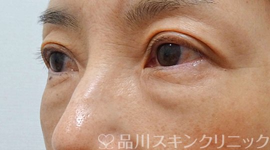 症例NO.69111のBEFORE写真