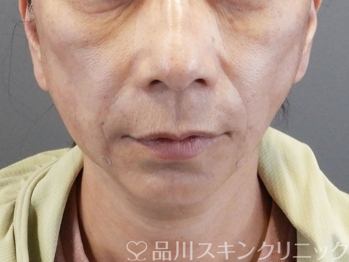 症例NO.65585のAFTER写真